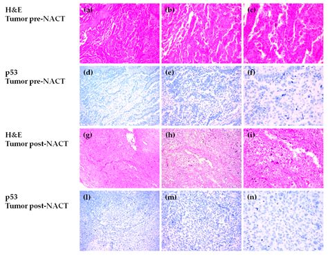 Clonal Evolution of TP53 c.375+1G>A Mutation in Pre- and Post- Neo ...