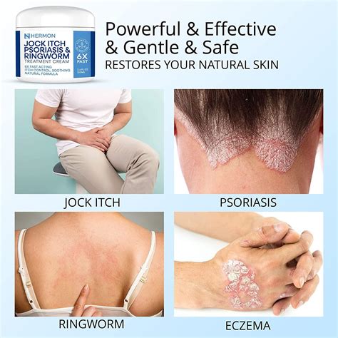 Antifungal Cream for Jock Itch, Psoriasis & Ringworm Treatment - 100g | Buy Now with Express ...
