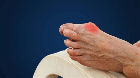 What Causes Joint Pain In Big Toe? | OnlyMyHealth