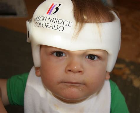 Babies Wearing Helmets For Flat Heads at Amber Magoon blog