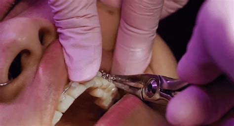 Weight Loss Jaw Wiring: Benefits, Selfcare, Risks & Cost