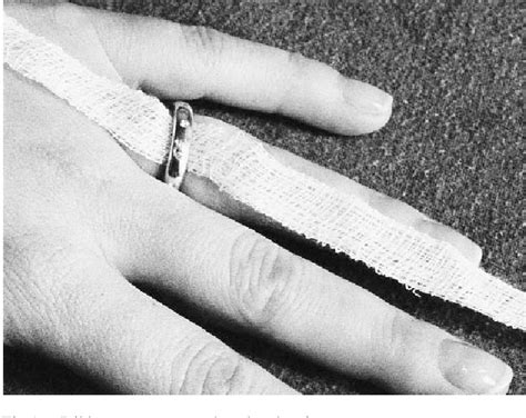 Image result for Ring Removal String Technique