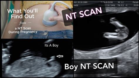 NT SCAN || How to Find Baby