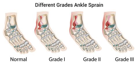 Ankle Sprains - The Foot and Ankle Clinic