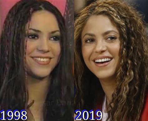 Shakira Before Plastic Surgery