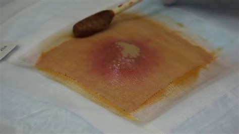 Image result for Abscessed Cysts Exploding