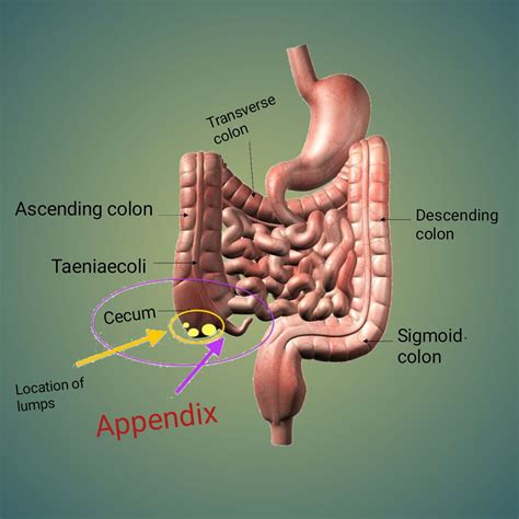 Appendicitis Education - Art Education