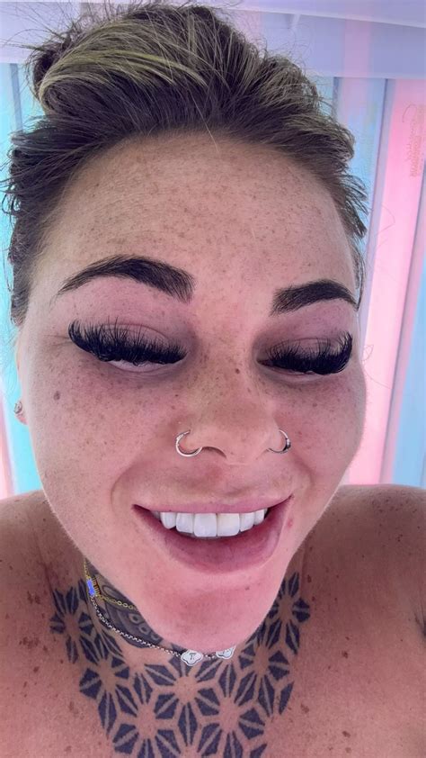 Influencer left horrified after accidentally burning skin off face ...