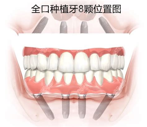 全口种植牙要种多少颗牙呢?常见有一次性全口种8颗或12颗,种植牙-8682赴韩整形网