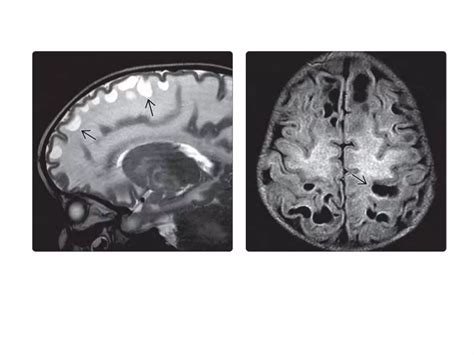 Approach to white matter disease | PPTX