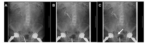 Image result for Retro Pyelogram Cystoscopy