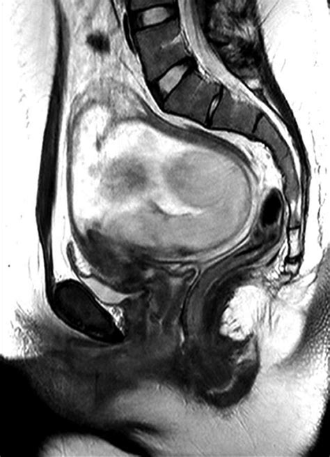 Retroflexed Uterus Mri