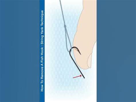 Image result for String Yank Method