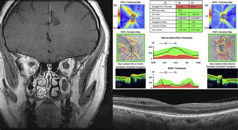 Microcystic Macular Edema in Optic Nerve Glioma - Ophthalmology