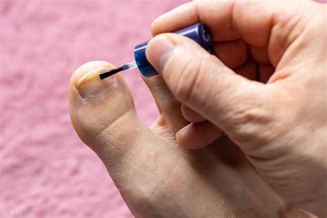 治疗灰指甲最有效的方法是什么？全程记录我的灰指甲治疗过程！ - 知乎