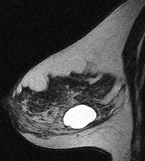 Cystic Masses of the Breast | AJR