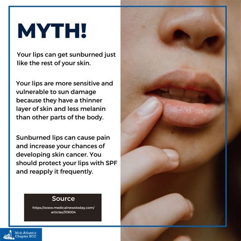 Mid-Atlantic Society of Cosmetic Chemists on LinkedIn: Myth! 💄 Your lips can get sunburned just ...
