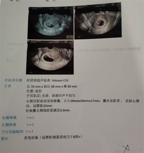 孕九周孕囊偏右侧近宫角最薄处39mm这种情况-好孕妈妈圈-好孕帮