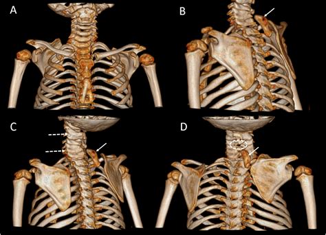 Klippel Feil Syndrome A Case Of Klippel–Feil Syndrome With