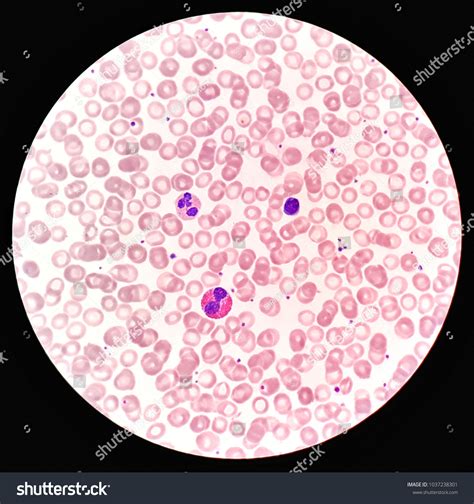 Differential Blood Count