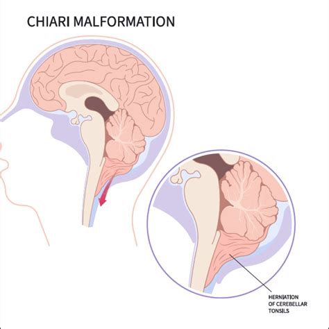 Chiari Malformations | Singapore Spine Center | Singapore