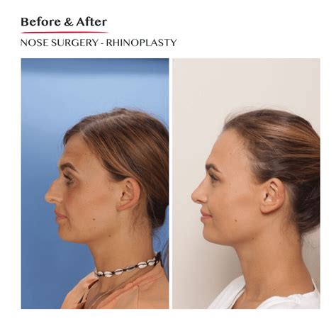 Rhinoplasty Surgery Dublin Ireland - Nose Job - Nose Correction Surgery