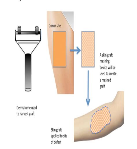 Skin Graft Surgery Process at Karen Evans blog