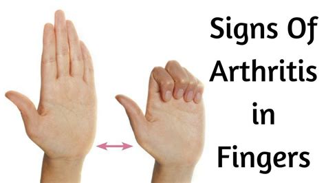 Pin on Arthritis Info