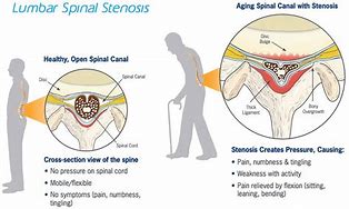 stenosis 的图像结果