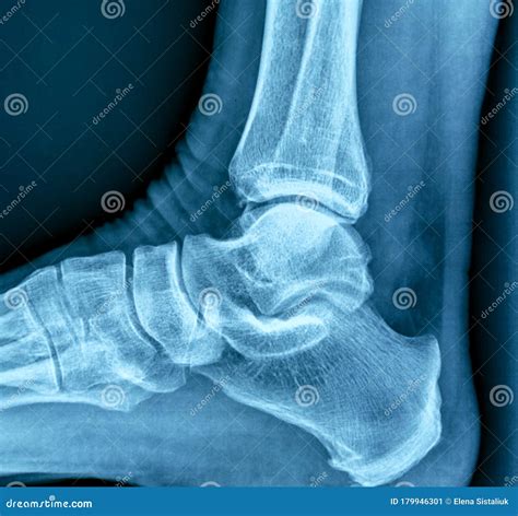 X-ray of human heel spur stock image. Image of surgery - 179946301
