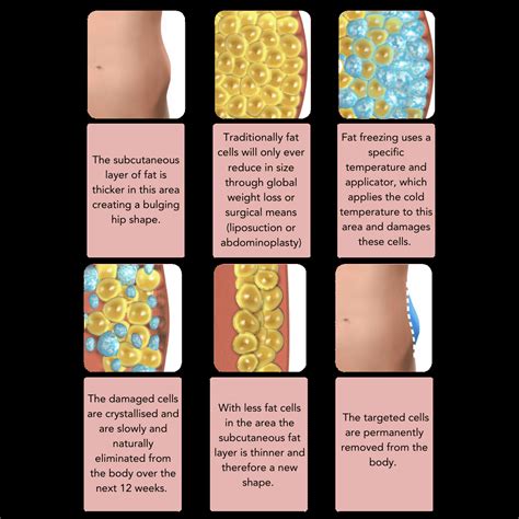 Does Fat Freezing Really Work? An In-Depth Look at Cryolipolysis