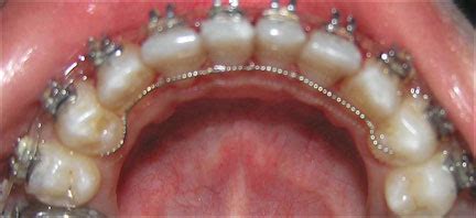 Image result for Retainer Problems