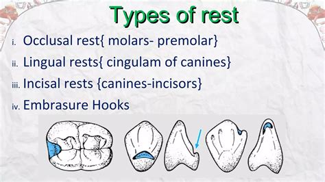 Rest and Rest Seat preparation..removable partial denture | PPT