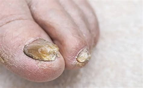 How Diabetes Increases the Risk of Fungal Nail Infections