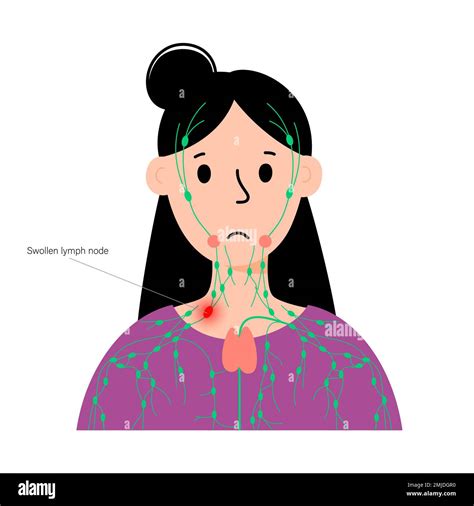 Medical Terminology For Swollen Lymph Glands at Bradley Johnson blog