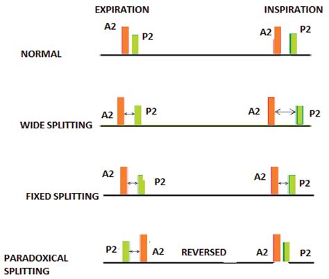 Second Heart Sound - Indian Journal of Cardiovascular Disease in Women