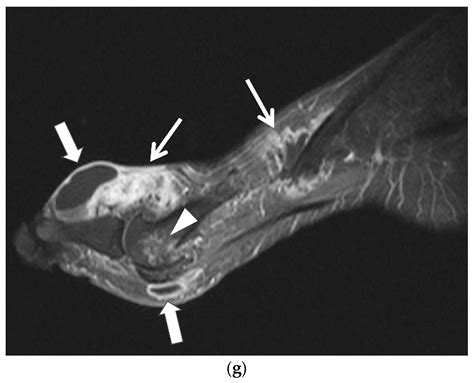 Gout Xray