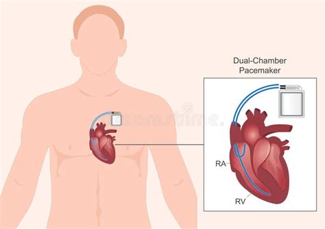 Pacemaker Procedure 的图像结果