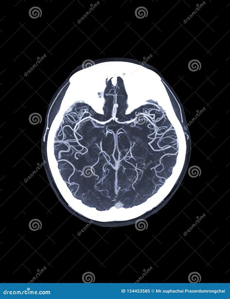 CTA Brain or CT Angiography of the Brain. Stock Image - Image of ...