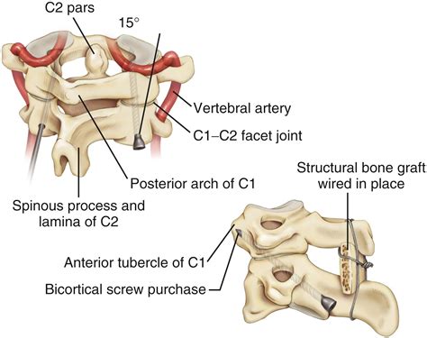 Lateral Mass Atlas