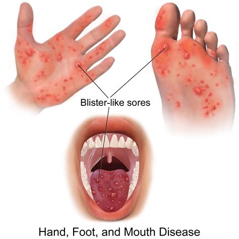 Hand Foot Mouth Throat