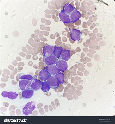 Стоковая фотография 1813535431: Blast Cells Peripheral Blood Smear ...