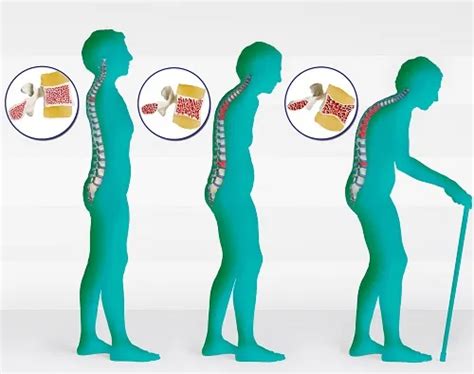 Osteoporosis: Early detection is the key to prevent fractures. - MedSpine