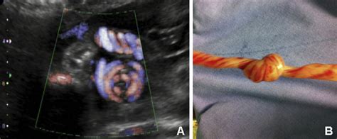 Bildergebnis für normal umbilical cord ultrasound