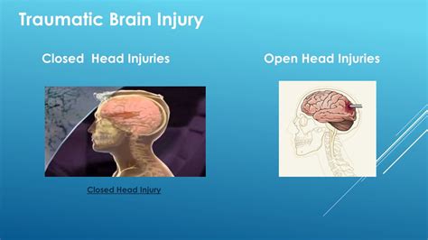 Open Vs Closed Head Injury : TBI (Traumatic Brain Injury): What It Is, Symptoms & Treatment – NHJQFI