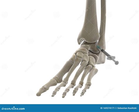 Image result for Ankle Injection Lateral Approach