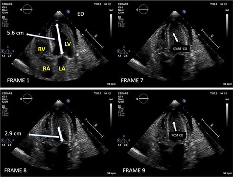 Left ventricular cavity obliteration: Mechanism of the intracavitary gradient and ...