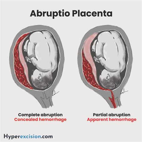 Placental Abruption (Abruptio Placentae) - Hyperexcision