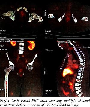 Excellent and Durable Response to Lutetium177 PSMA Therapy in a ...