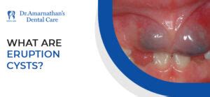 Image result for Exploding Mouth Cyst